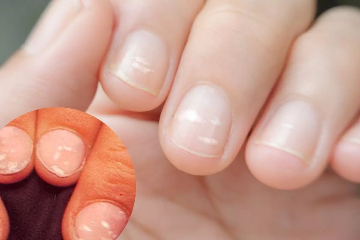 Taches Blanches Sur Les Ongles Causes Et Solutions 7490