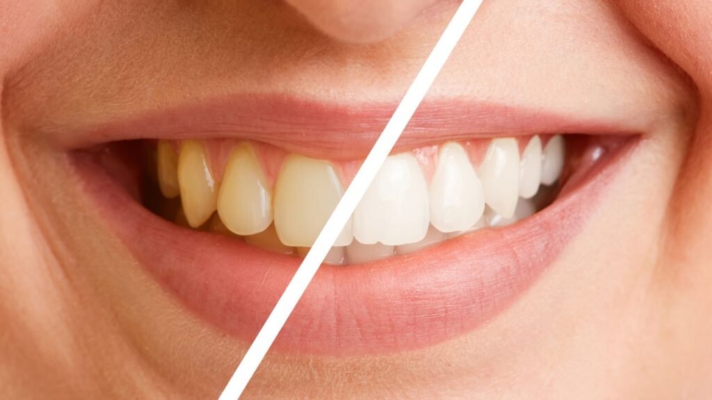 Pourquoi les dents changent-elles de couleur au fil du temps ? Causes et solutions.