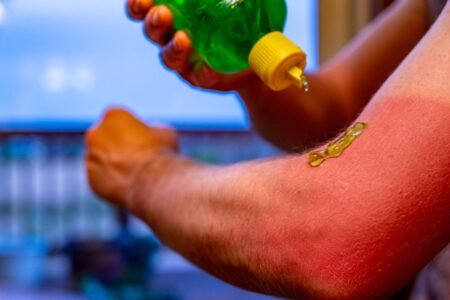 Application d'aloe vera sur un coup de soleil sur le bras